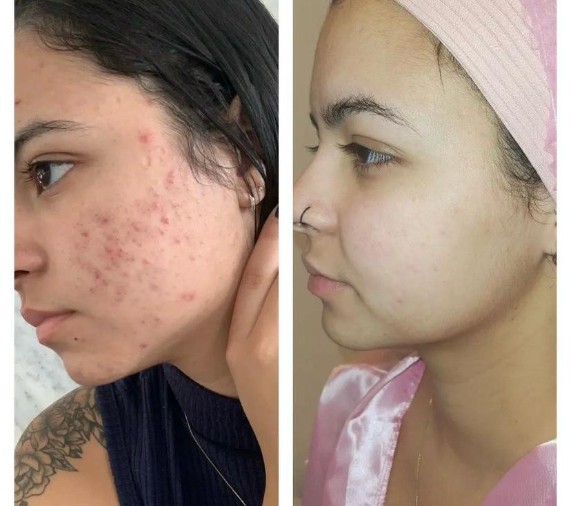 Tratamento de Acne