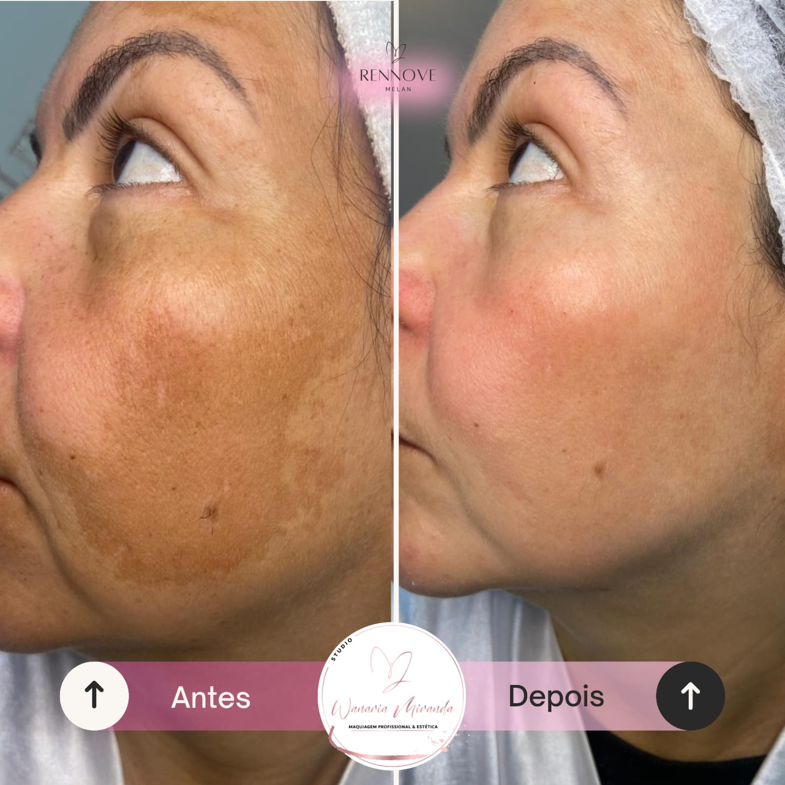 Tratamento de Melasma